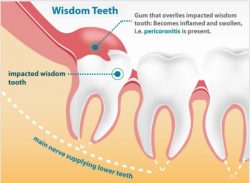 Wisdom Tooth Pain Relief | Wisdom Teeth Pain Symptoms