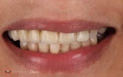 Procedure for Dental Crowns