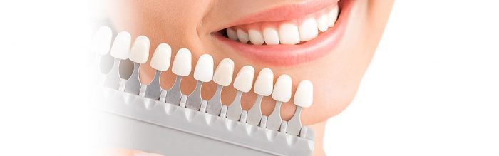 Different Types of Veneers | Dentist Veneers Houston