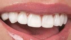 How Much Do Veneers Cost? | Full Mouth Dental Veneers Cost Texas