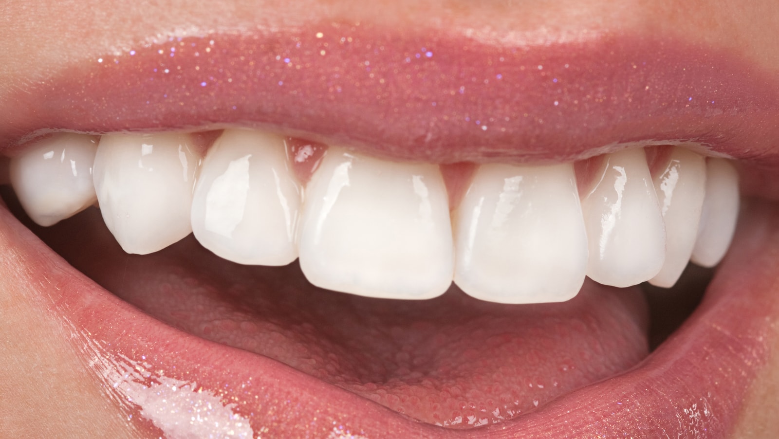 How Much Do Veneers Cost? Full Mouth Dental Veneers Cost Texas