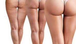 What Is A Brazilian Butt Lift Surgery?