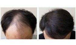 Best Hair Transplant and Hair Loss Treatment In India By Dr. Vivek Kumar