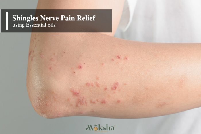 10 Best Essential Oils for Shingles Nerve Pain Relief