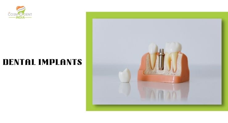 CosmodentIndia For Best Dental implants Cost