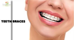 CosmodentIndia For Teeth Braces Cost Price