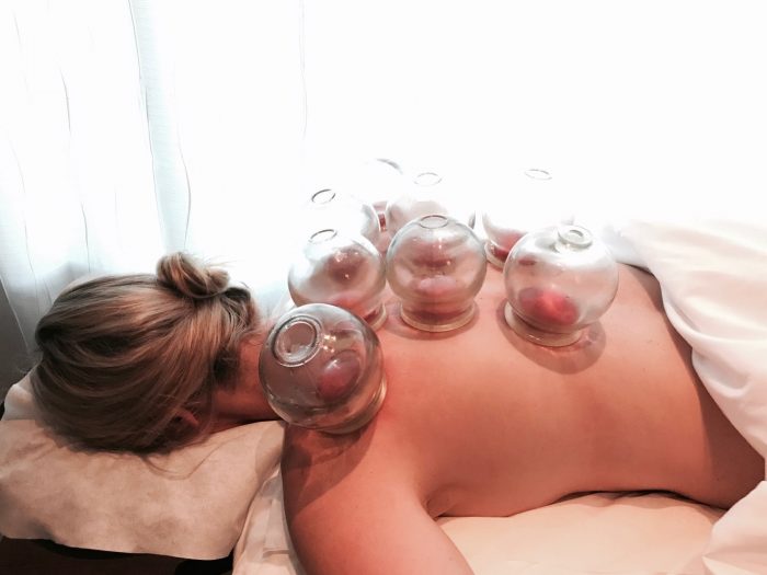 Best Cupping Therapy in San Jose