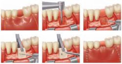 Teeth Grinding Treatment Houston TX | Bruxism Symptoms & Causes – Sapphire Smiles