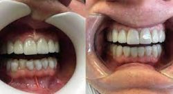 Dental Veneers Near Me | Composite Bonding vs Porcelain Veneers