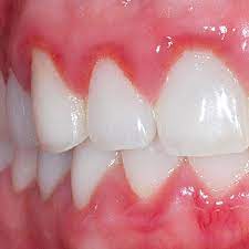 What is Gum Disease and Periodontal Disease? | Dental Clinic In Tanglewood