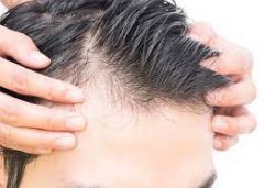 Reverse Thinning Hair For Men