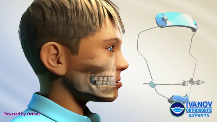 Clear Ceramic Braces For Adults | Ivanov Orthodontics For Your Clear Braces