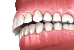 Braces Before and After Overbite: Causes, Symptoms, Treatments