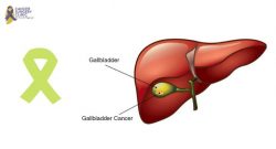 Surgeon Doctor For Gallbladder Cancer Treatment