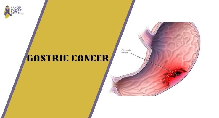 Surgeon Doctor For Gastric Cancer Treatment