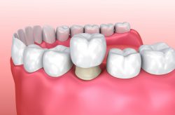 Dental Crown Near Me | Types of Dental Crown Procedure