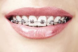 Adult Orthodontics Miami | Adult Orthodontics Near Me