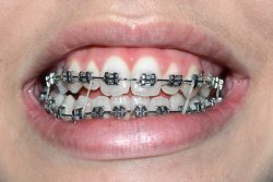 Braces Rubber Band Colors | Intra-Arch Rubber Bands | Orthodontic Treatment