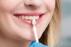 How to Get Rid of Stains on Teeth | Porcelain Laminate Veneers