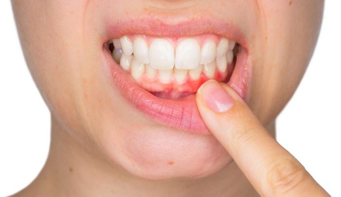 Gum Disease & Periodontal Disease – Urbn Dental