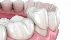 Porcelain Crown Cost Houston | Tooth Crown Before And After