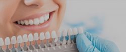 Dental veneers: cost and types | Doctor In Uptown