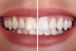 8 Over-the Counter Teeth-Whitening Truths Only Your Dentist Knows