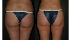 Fat Transfer Buttock Augmentation