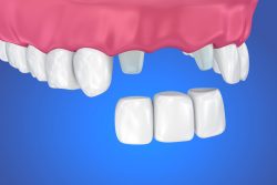 Dealing with Cracked Teeth, Lost Fillings and Crowns
