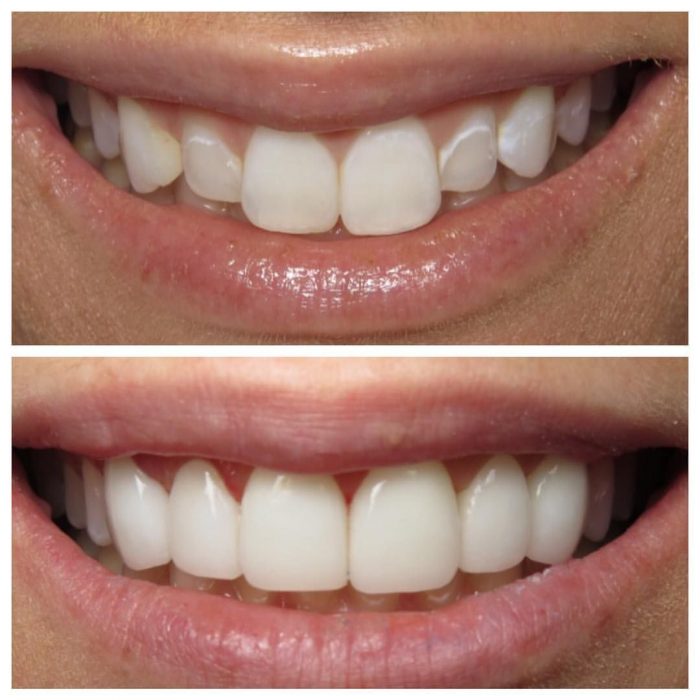 How Much Does Veneers Cost?