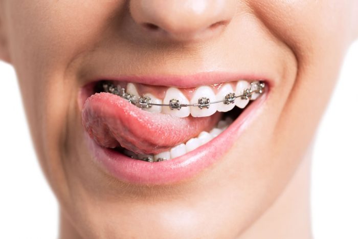 Getting Braces And What You Should Know | Ivanov Orthodontic Experts