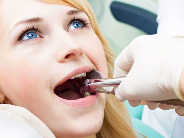 Same-Day Tooth Extractions | Simple And Surgical Tooth Extraction