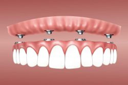 Stages of the Dental Implant Procedure: