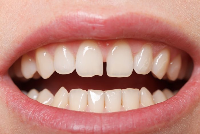Cost of Veneers for Teeth Gaps