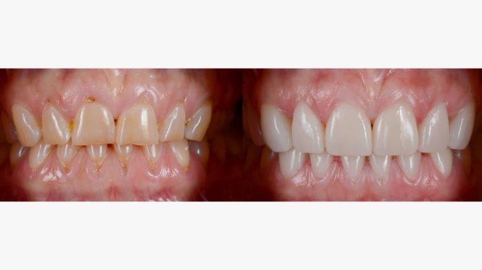 How much do veneers cost per tooth?