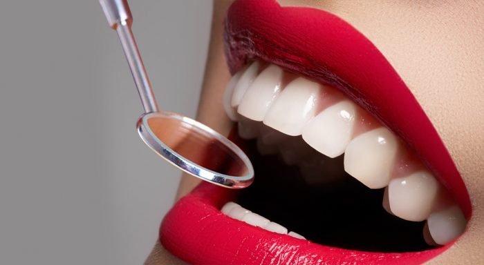 What Are Dental Veneers?