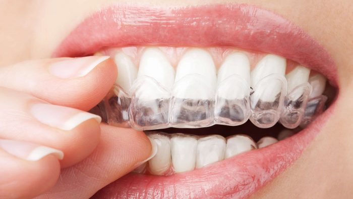 Find an Invisalign Doctor Near Me