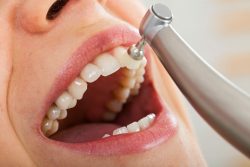 Dental Teeth Cleaning Houston | Dental Examinations & Fluoride Treatment