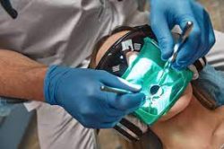 Root Canal Treatment Cost In Houston, TX