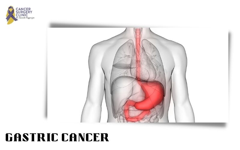 Treatments Of Gastric Cancer By CancerSurgeryClinic