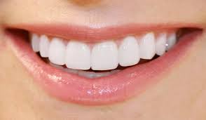 Dental Veneers: How Are They Made? | URBN Dental Midtown | Dentist Houston