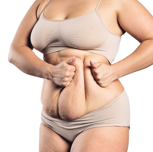 Tummy Tuck South Africa: The Best Way to Restore Your Youthful Waistline