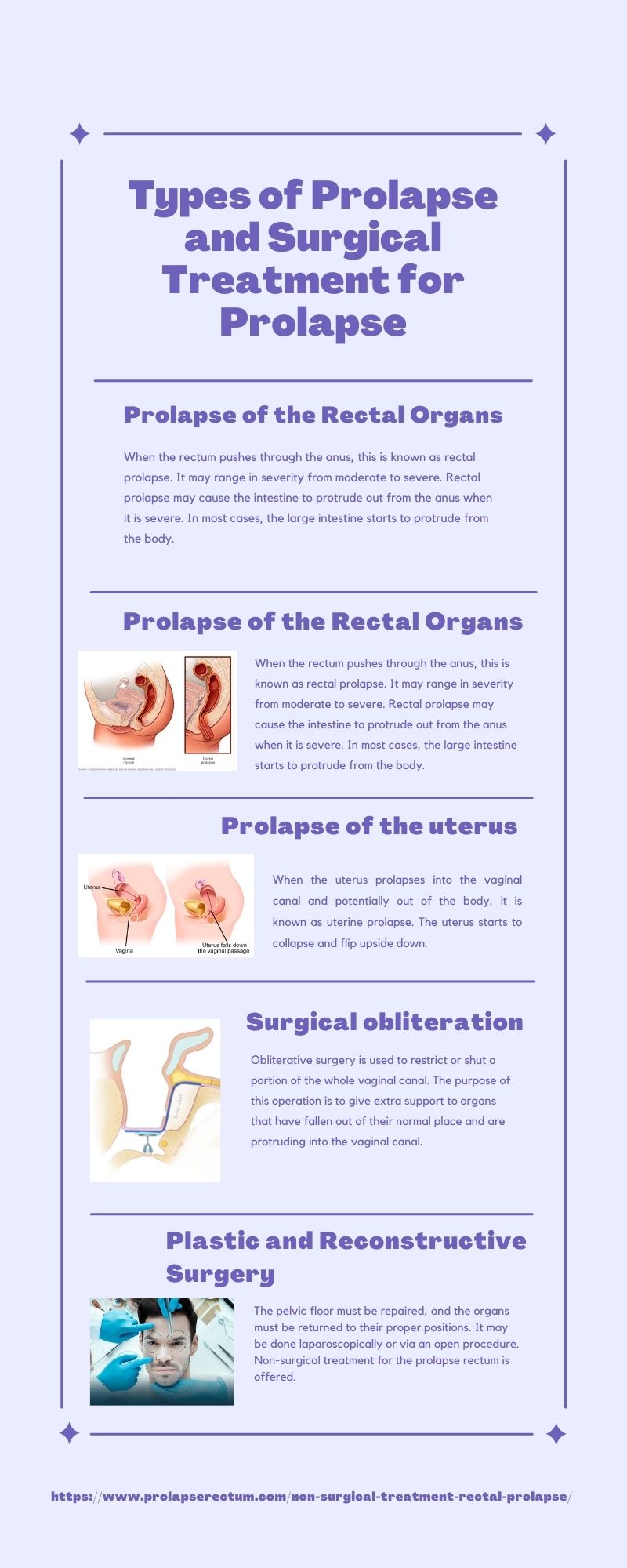 Types of Prolapse and Surgical Treatment for Prolapse