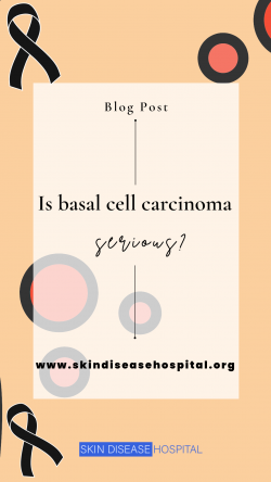 Is basal cell carcinoma serious? – Skin Disease Hospital