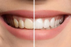 Teeth Whitening and Teeth Bleaching