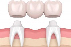 Find cantilever bridge dental