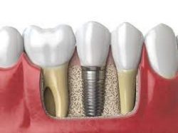 Best Dental Implants in Houston, TX