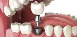 Tooth Implant Treatment in Houston, TX