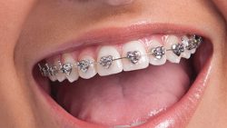 The Benefits of Power Chain Braces