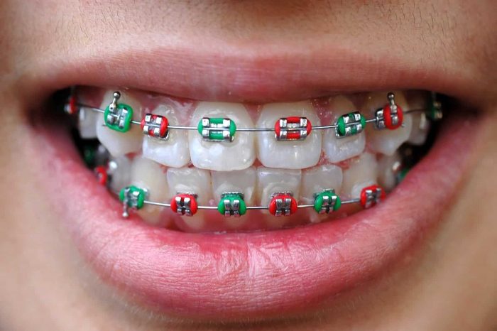 Braces power chain colors
